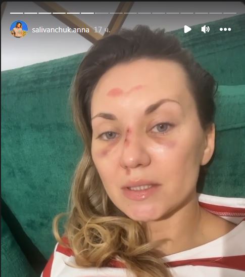 Струс мозку та зламаний нос: Ганна Саліванчук шокувала результатом невдалого падіння (фото)